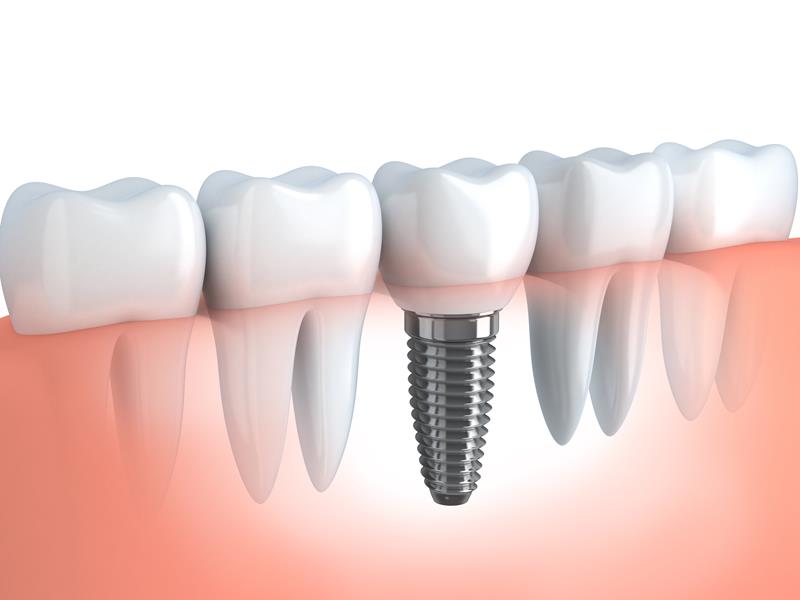 Dental Implants  Brea, CA 